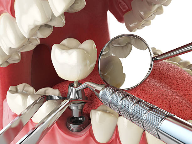 Best Emergency Root Canal Treatment in Ipswich, SD